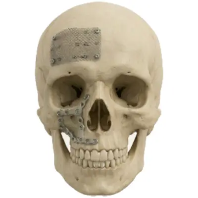 Craniomaxillofacial