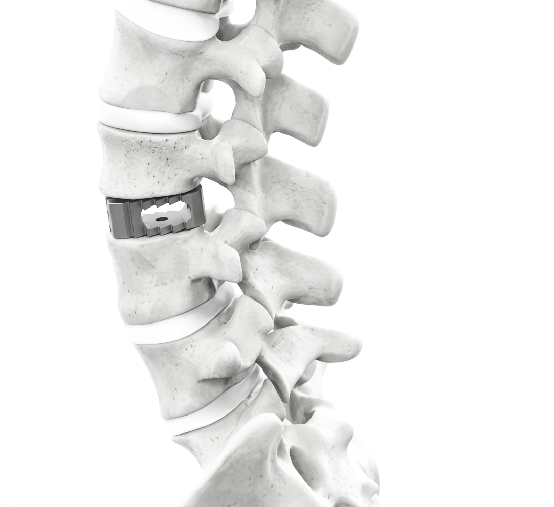 Lumbar Spinal Cage System
