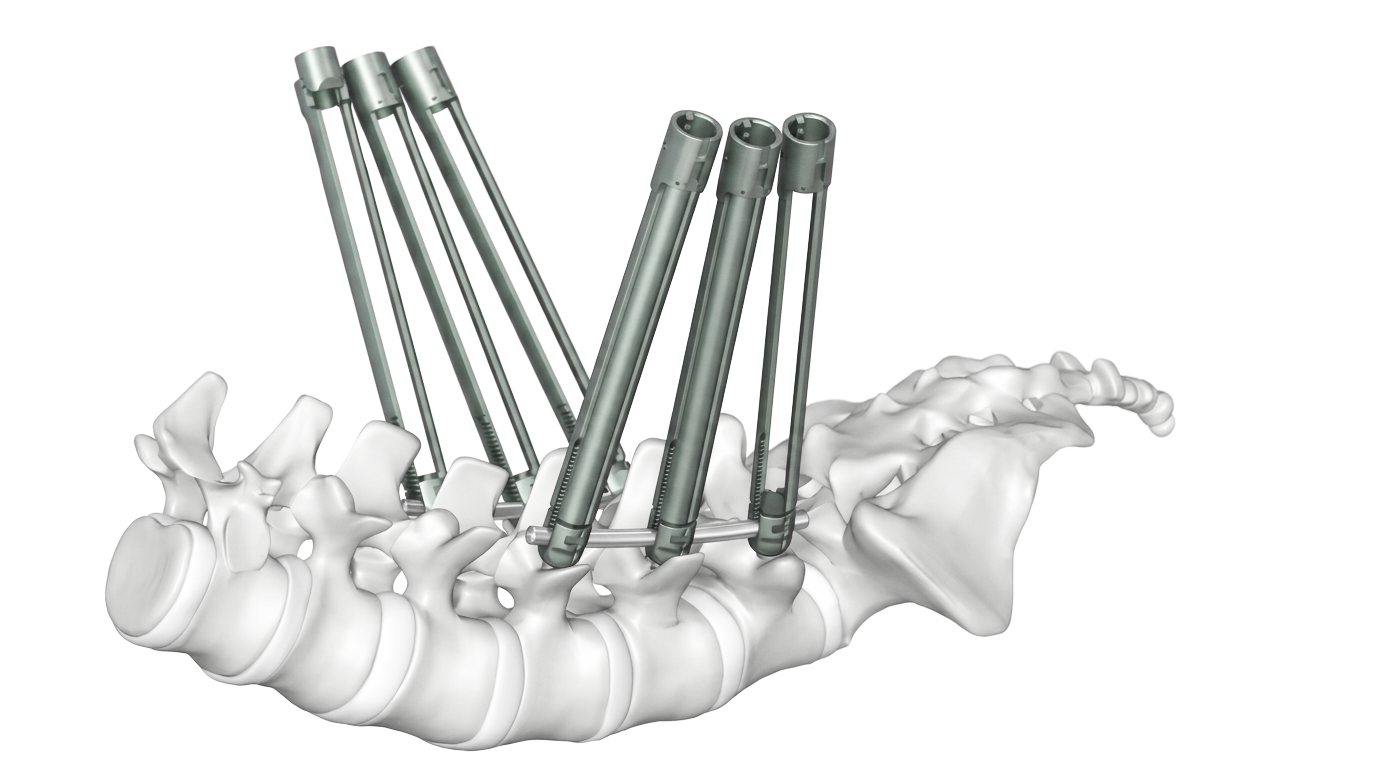 Minimally Invasive Pedicle Screw System