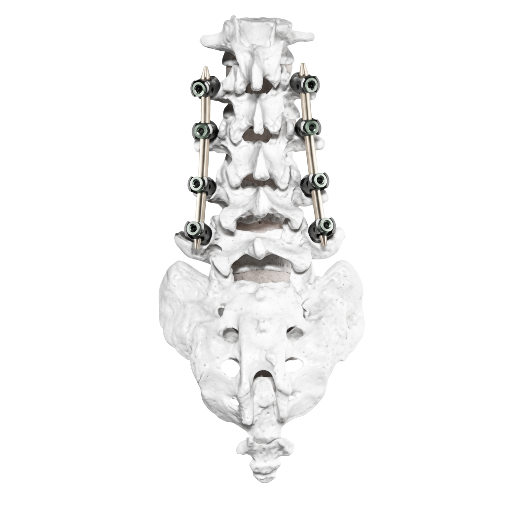 Pedicle Screw System