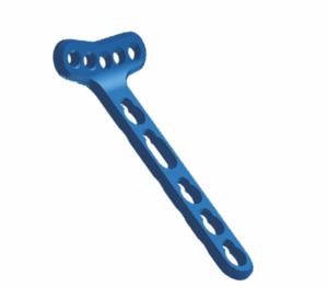 2.4 mm Volar Distal Radius Locking Plate – Extra-Articular (5 Holes in Head, Left/Right)