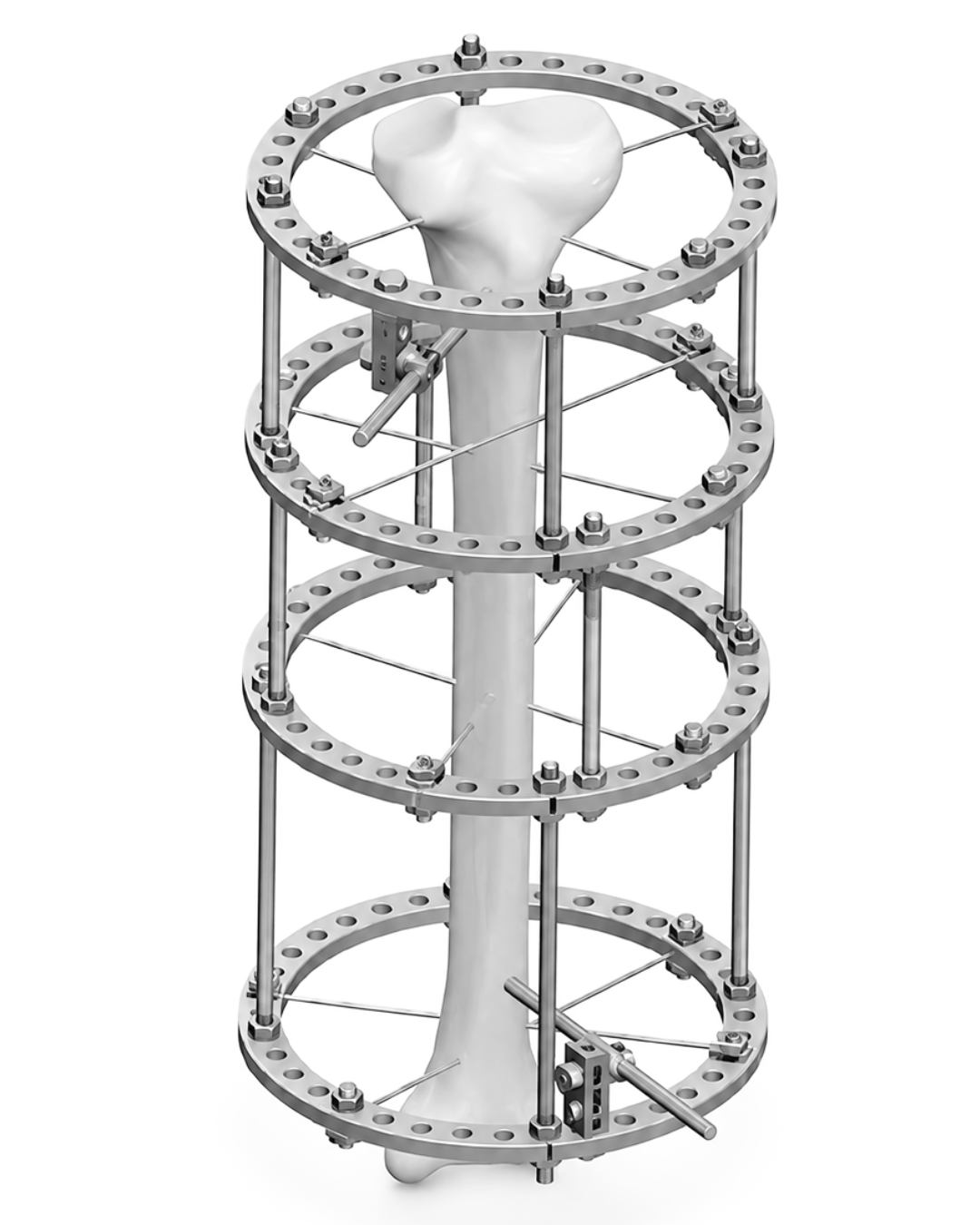 Pediatric Fixators