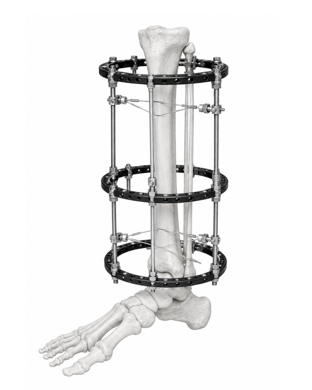 Ilizarov Ring Fixator System