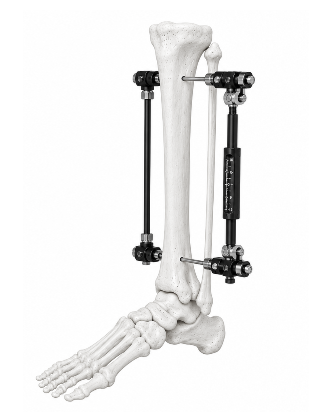 Dynamic Fixator System