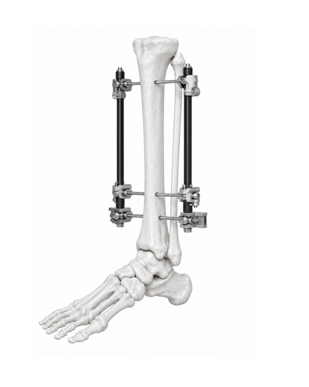 Hoffman2 Type Fixator System